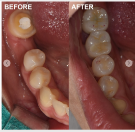 검단가온치과 임플란트 전후사진