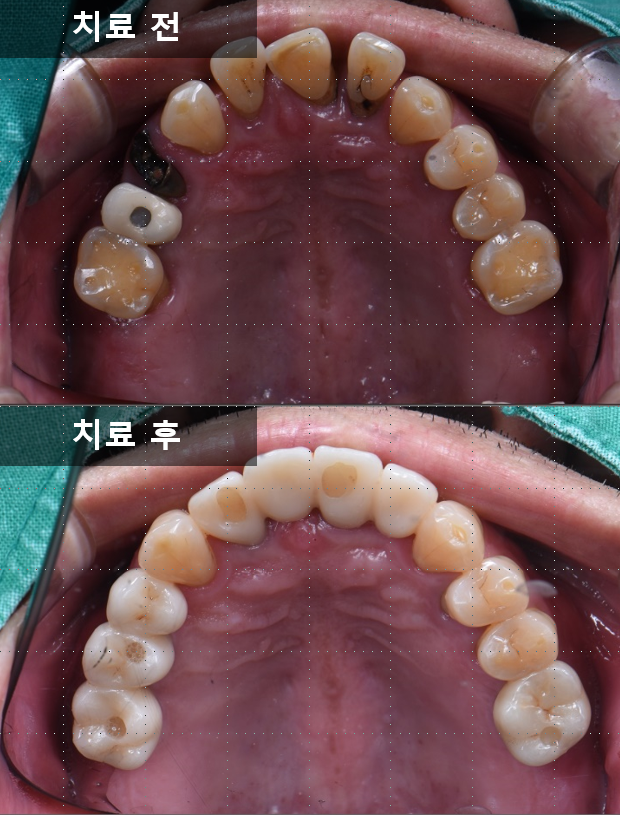 검단가온치과 임플란트