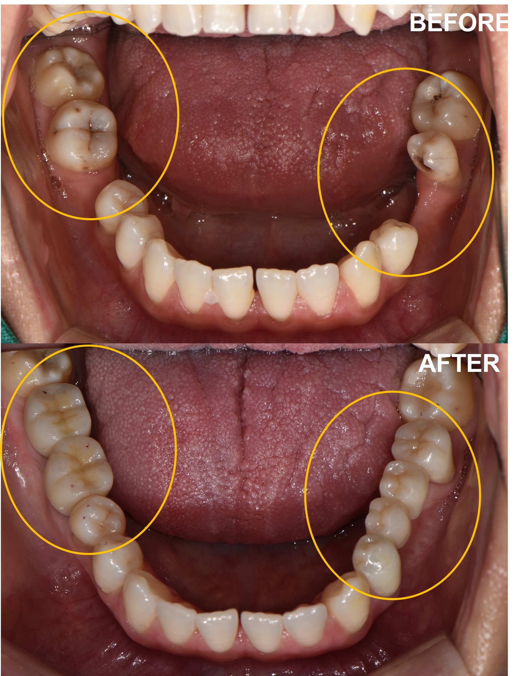 검단가온치과 임플란트