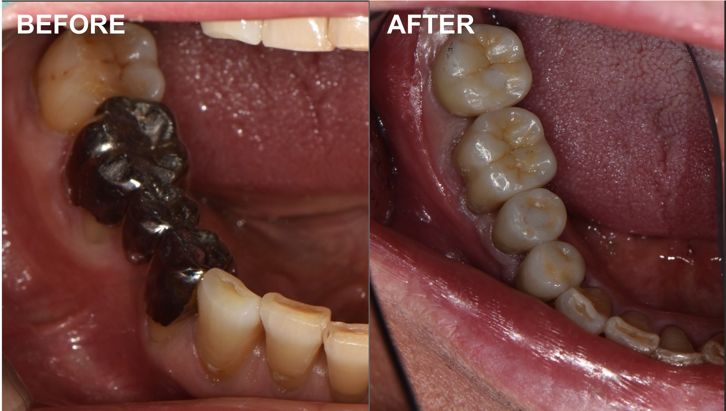 검단가온치과 임플란트