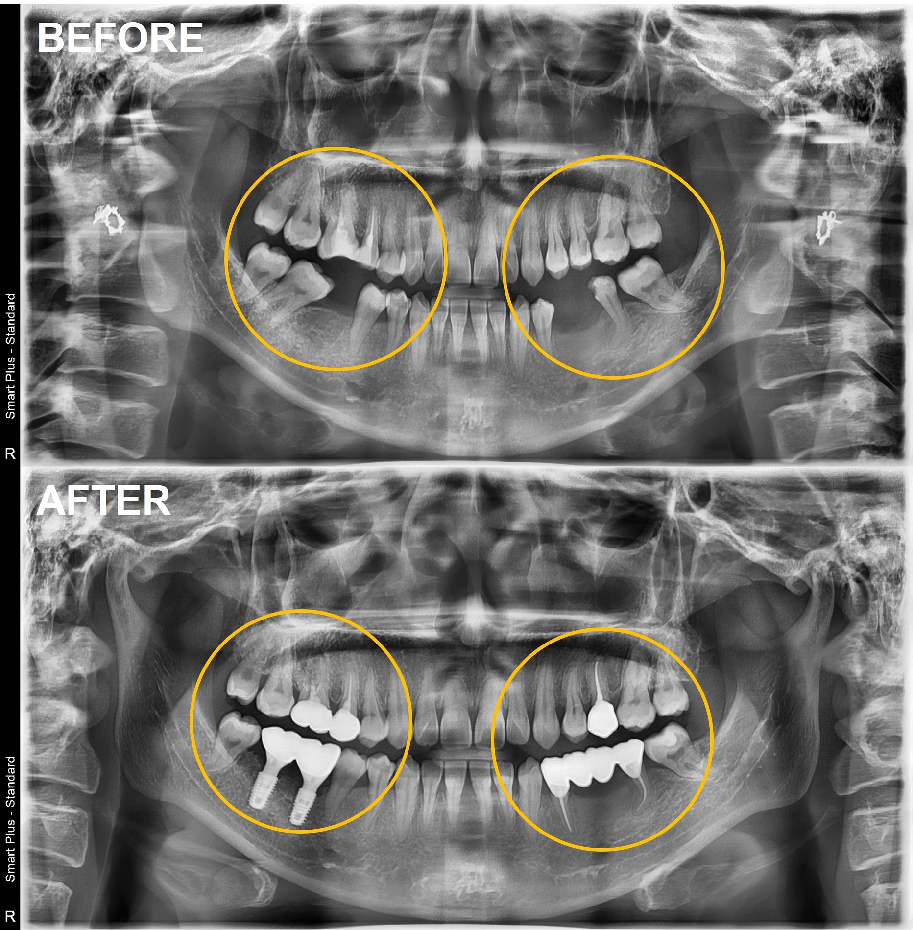 검단가온치과 임플란트