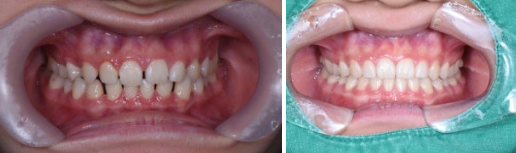 치아교정 전후 비교