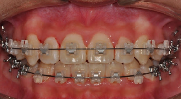 자가결찰 브라켓(교정 장치) 예시