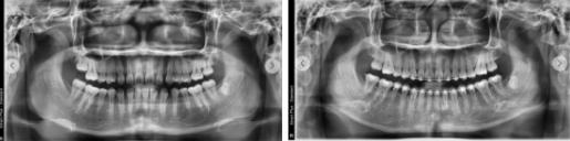 부정교합 치료 전후 파노라마 X-ray(엑스레이)