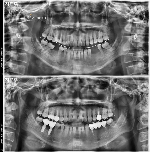 교합평면 변화 비교 자료
