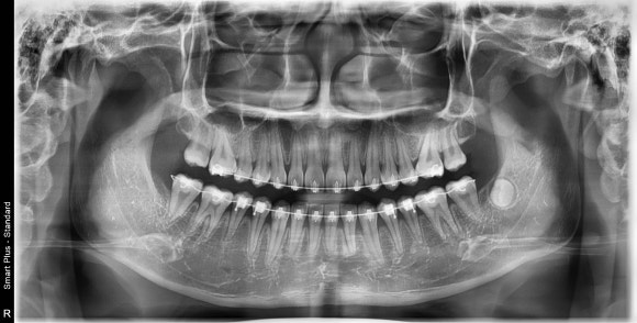 실제 촬영 이미지 — 검단가온치과 정밀 검사 X-ray