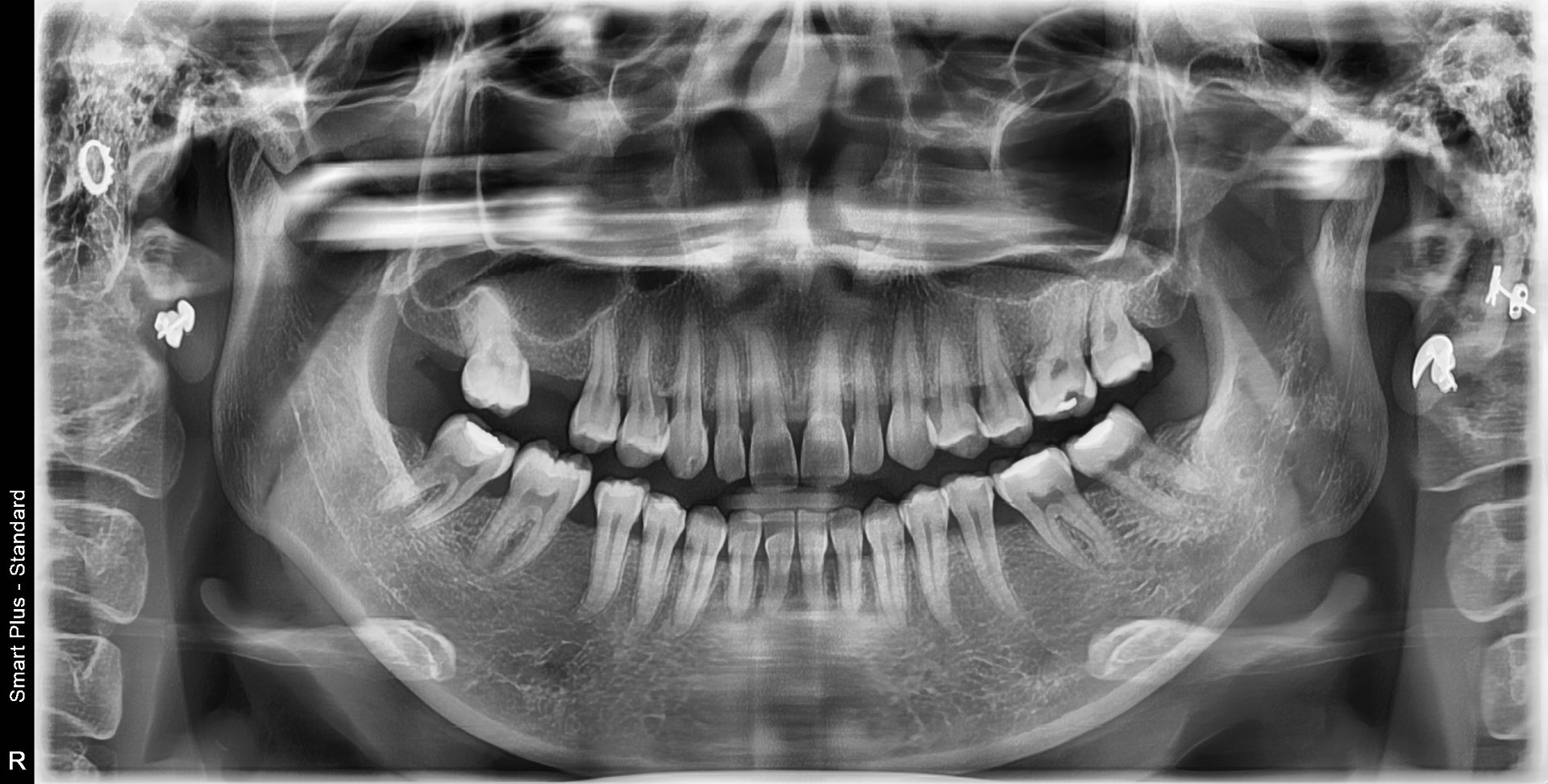 파노라마 X-Ray — 전체 치아·뼈 상태 확인