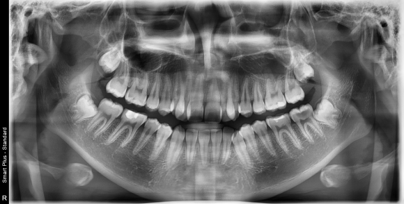 교정 진단에서 활용하는 파노라마 X-Ray 예시