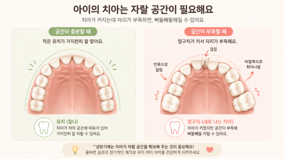 악궁 공간 부족 개념 인포그래픽