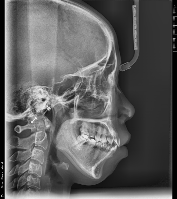 측면 세팔로 X-Ray